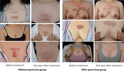 Sports Bras Improve Chest Keloids but Outcomes Are Dependent on Breast Size: A Retrospective Analysis